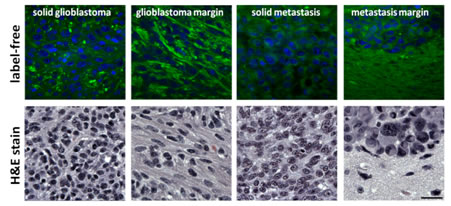 Glioblastoma multiform and breast cancer brain metastasis